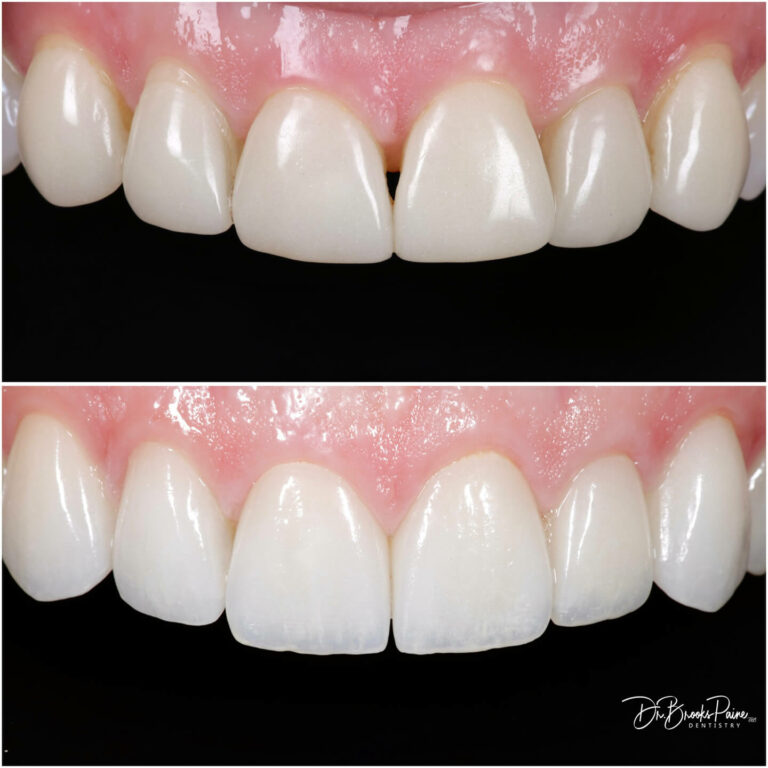 Dental veneers before and a after patient photos