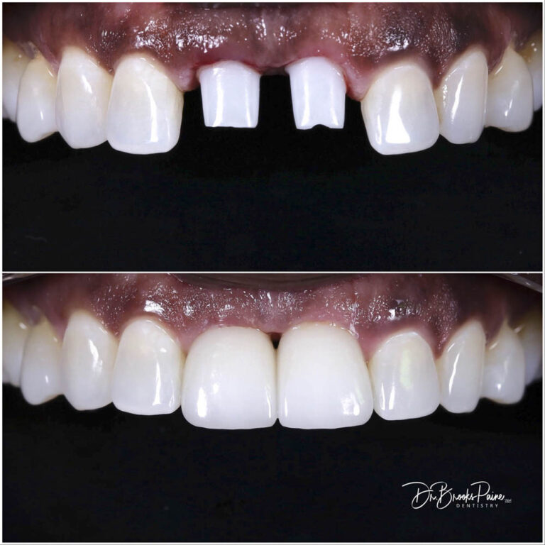 Before and after of teeth