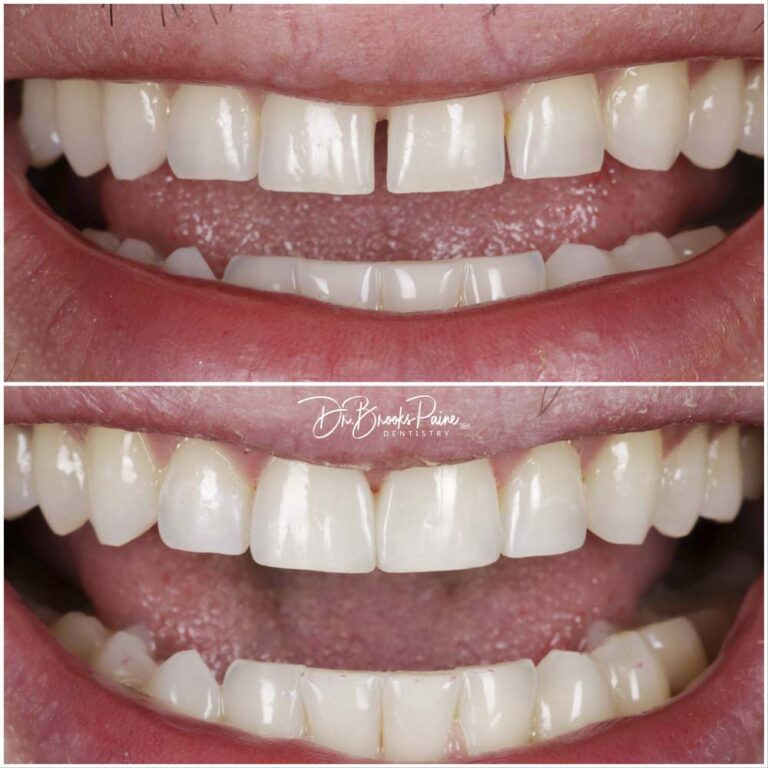 Before and after of teeth