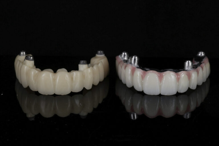 Before and after of dental implants