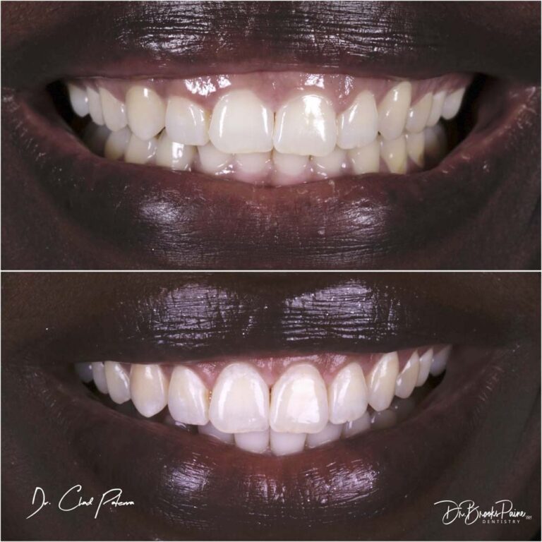Closeup of teeth before and after dental procedure