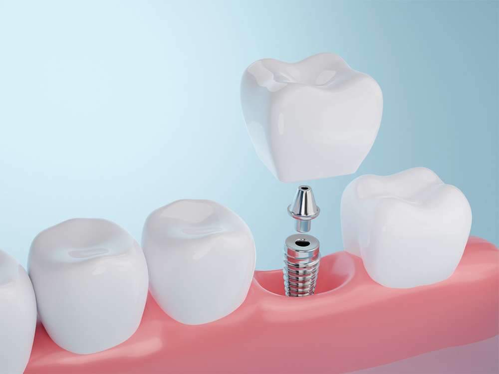 Illustration of a dental implant, abatement and crown fitting into gums
