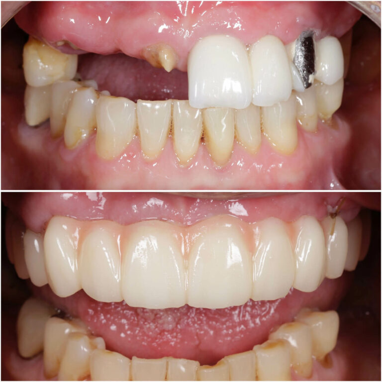 Dental implants before and after photos