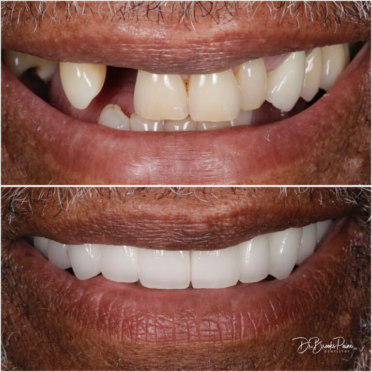 Dental implants before and after photos