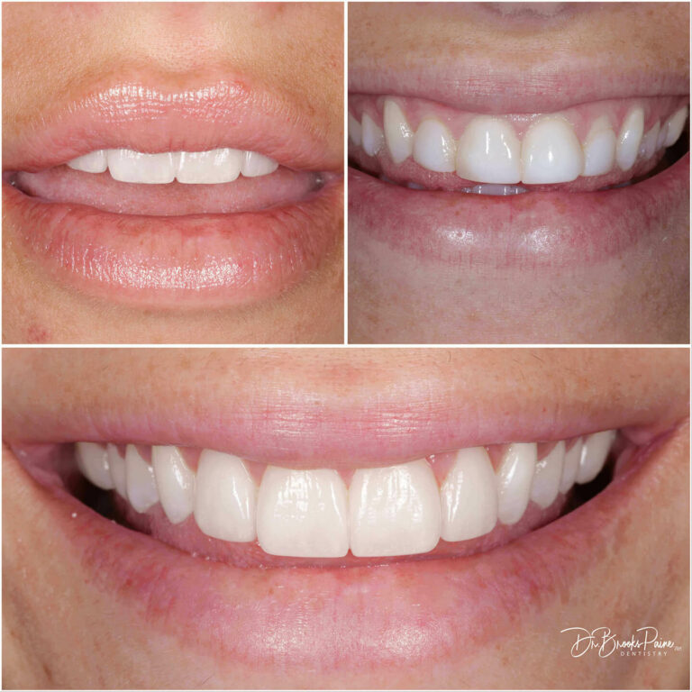 Dental veneers before and a after patient photos